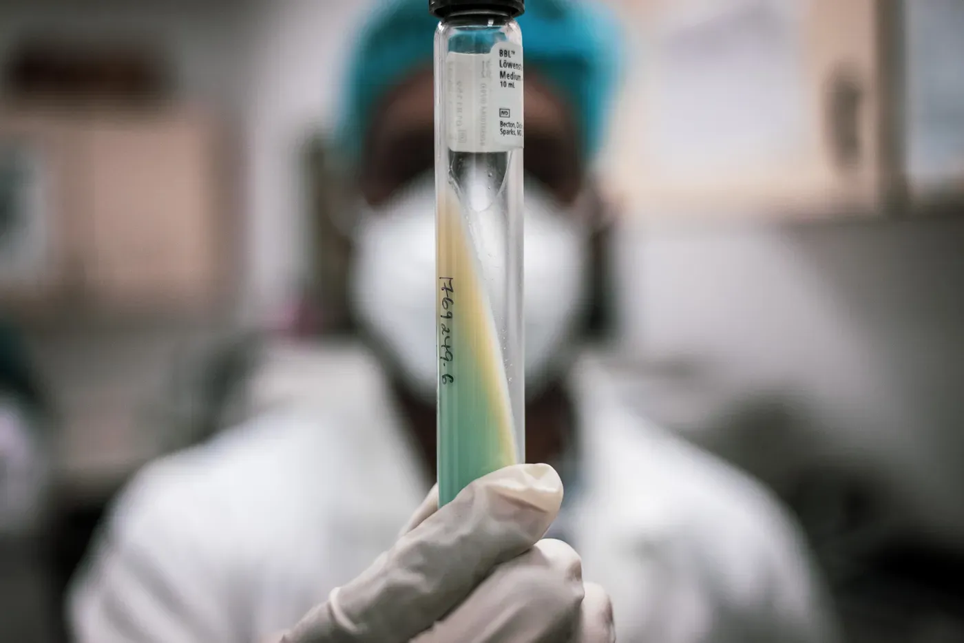 La tuberculosis tiene un aumento en muertes a causa del covid-19