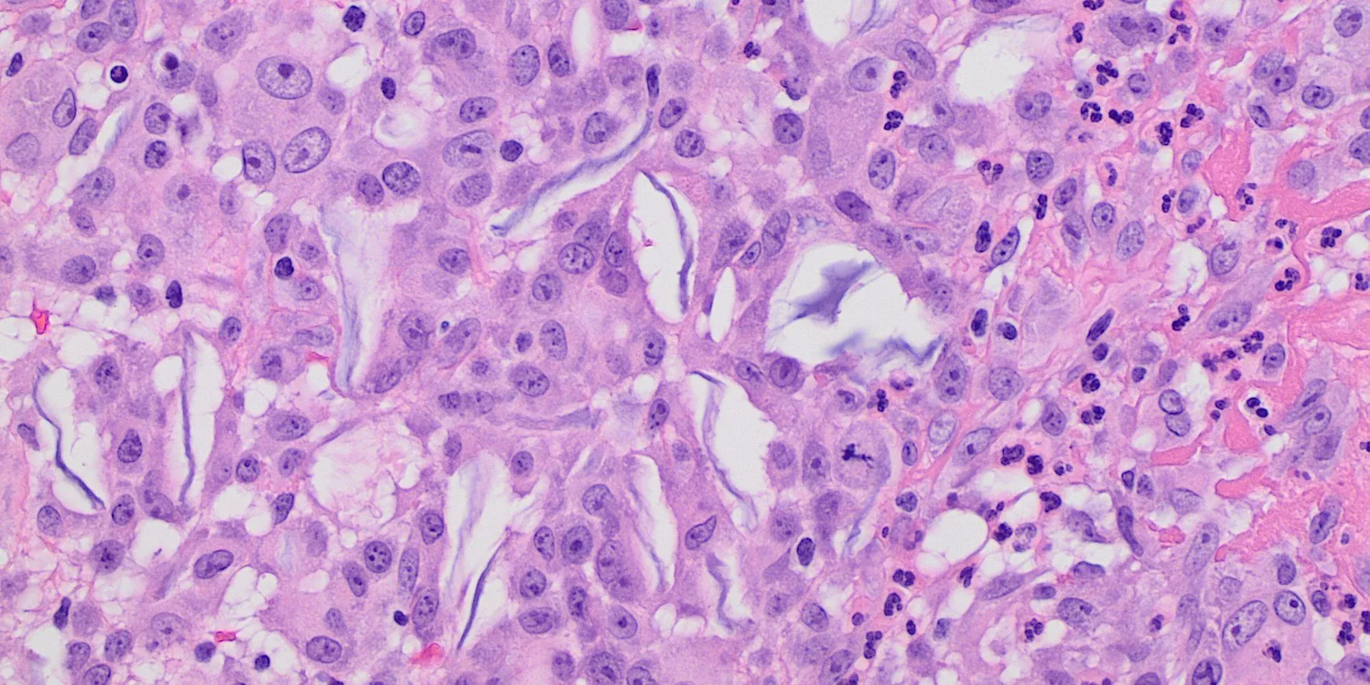 keratin cysts