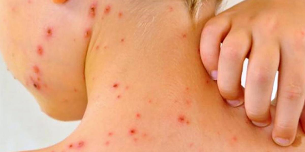 Sarampión El Regreso Del Virus Columna Digital