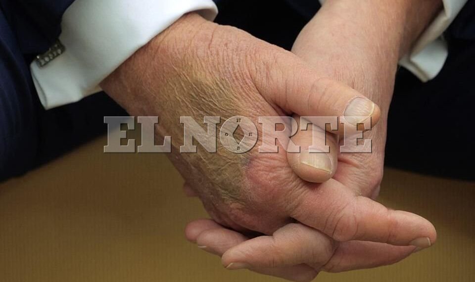 ¿Qué le pasó a Donald Trump en la mano?