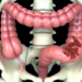 Diverticulitis, la patología que afecta a la mitad de la población por encima de los 50 años