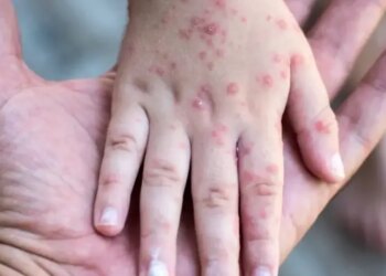 ¿El sarampión es más contagioso que la COVID-19? Esto dicen en la UNAM