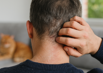 Is It Dandruff—Or Are You Dealing with Scalp Psoriasis?